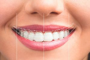 cursos estetica dental en cancun Cosmética Dental Azuna Cancún