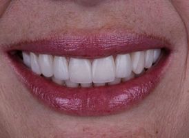 blanqueamientos dentales en cancun Cosmética Dental Azuna Cancún