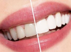 blanqueamientos dentales en cancun Cosmética Dental Azuna Cancún