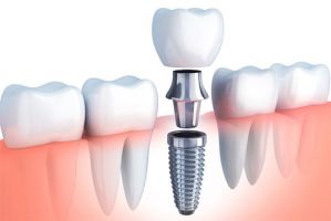 cursos estetica dental en cancun Cosmética Dental Azuna Cancún