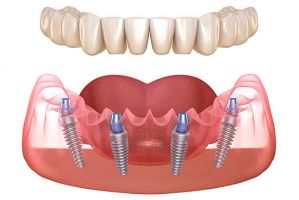 cursos odontologia cancun Cosmética Dental Azuna Cancún