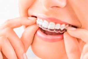 blanqueamientos dentales en cancun Cosmética Dental Azuna Cancún