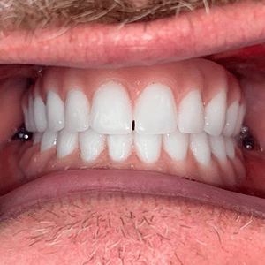 All-on-4 dental implants before and after cancun dentistry german arzate (39)