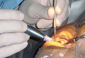 Cirugías de Retina