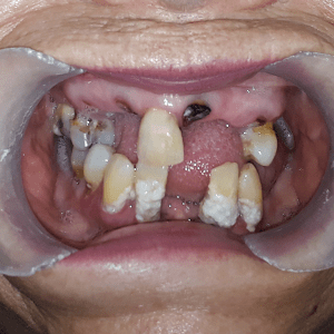 Snap in Dentures mini implant before and after german arzate dds (10)